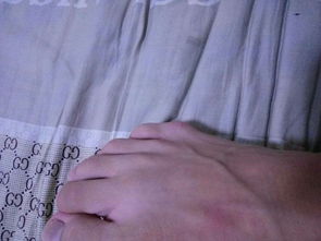 我穿籃球鞋,小腳趾下關節處張了個鼓包,摸著像骨頭,穿硬一點的鞋又特別疼 怎么辦