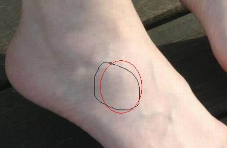 腳崴后骨頭突起 解剖解析與科學處理指南