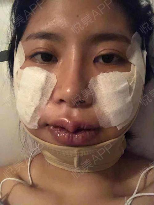 顴骨顴弓整形 專業(yè)診斷與個(gè)性化方案的重要性